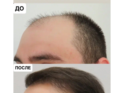 До и после пересадки волос
