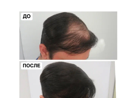 До и после пересадки волос