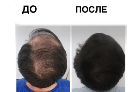 До и после пересадки волос